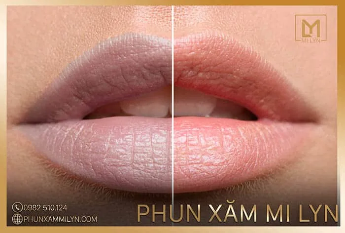 Khử thâm môi nam nữ Hải Phòng