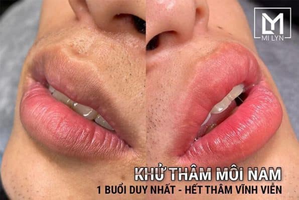 Phun Xăm Mi Lyn - địa chỉ khử thâm môi nam tốt nhất Hải Phòng