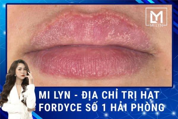 Chữa trị hạt bã nhờn fordyce trên môi Hải Phòng