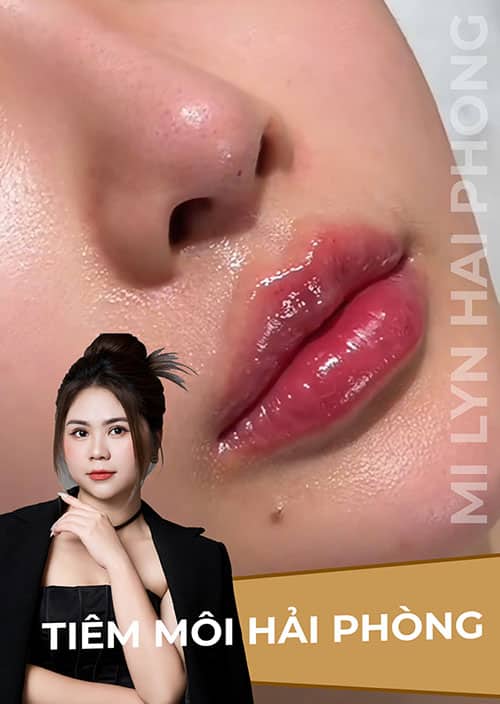 Tiêm filler môi hải phòng Mi Lyn