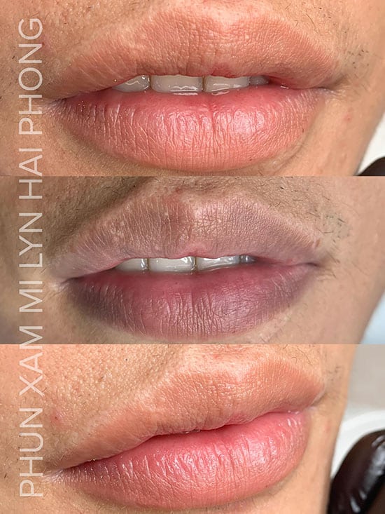 Giá khử thâm môi nam hải phòng bao nhiêu tiền